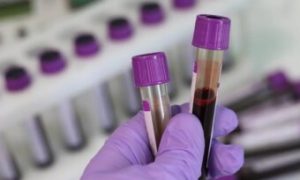 KCCG bez dva tumor markera: Testovi bi trebalo da budu dostupni do sredine septembra